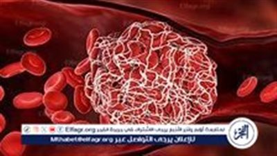 علامات تشير إلى الإصابة بالجلطة الدموية: الأعراض التي لا يجب تجاهلها