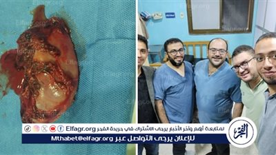 إنقاذ حياة طفل عقب استئصال الطحال والكلى اليسرى بمستشفى الجمالية بالدقهلية