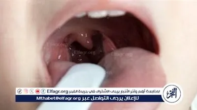الوقاية من احتقان الزور وأهميتها لصحة الجهاز التنفسي