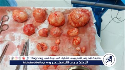نجاح فريق طبي في استئصال 20 ورم ليفي من رحم فتاة بمستشفى ميت غمر في الدقهلية