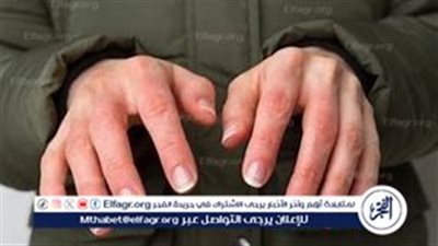 الدكتور حسام موافي يكشف أسباب برودة الأطراف وارتباطها بالأنيميا