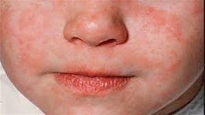 بعد انتشاره في المغرب.. ماذا تعرف عن بوحمرون؟