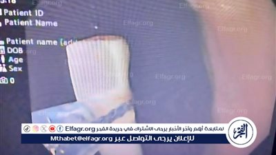  إنجاز طبي جديد في مستشفى العامرية في الإسكندرية باستخراج جسم غريب من معدة طفل باستخدام المنظار (صور)