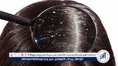 كيفية التخلص من قشرة الشعر: حلول منزلية وأنواع القشرة