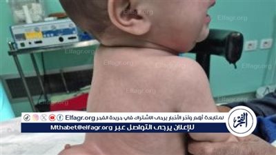 إنجاز طبي نادر بالإسكندرية.. فصل توأم طفيلي دون رأس عن رضيعة عمرها 4 أشهر