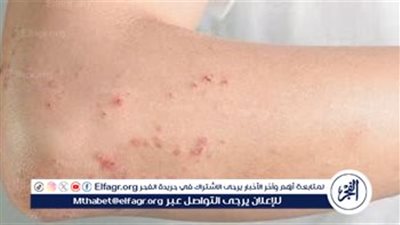 كل ما تريد معرفته عن لقاح الحزام الناري: الفوائد والجرعات والموانع