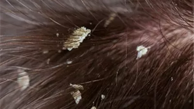 قشرة الرأس في الشتاء: أسبابها وطرق التخلص منها