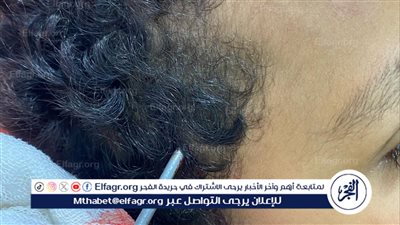 مستشفي جامعة قناة السويس تجري جراحة دقيقة تنقذ طفلا من الموت بعد اختراق سيخ معدني لرأسه