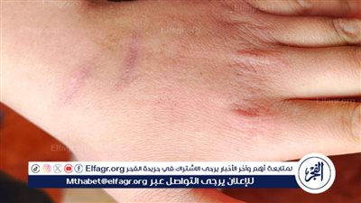 زوج يتهم زوجته بإصابة نجلهما بحروق في جسده بالبحيرة