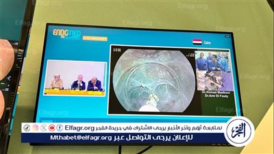 إنجاز طبي عالمي لجامعة حلوان: بث حي لجراحة بالمنظار يحصد إشادة دولية