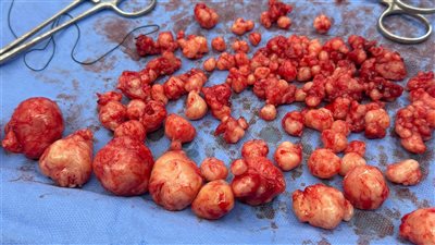 طبيب ينجح في استئصال 121 ورمًا ليفيًا من رحم شابة سودانيه دون استئصاله