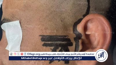 نتيجة اندماج العظام والأنسجة.. جراحة دقيقة وغير مسبوقة لشاب بمستشفى العامرية في الإسكندرية 