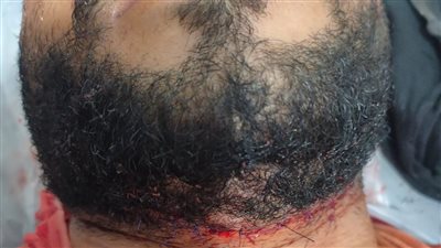 القبض على عاطل بالفيوم تعد على عامل بمحل كشري وأصابة بحرخ ذبحي بالرقبة