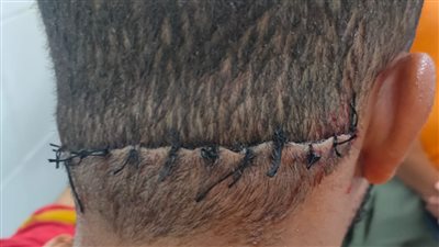 مصادر طبية بالفيوم العام استقرار الحالة الصحية لعامل الكشري بعد إصابتها بجرح قطعي بالرقبة