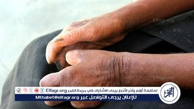 عاجل- مصر على مشارف إعلان خلوها من الجذام نهائيًا بحلول 2030: جهود حكومية متكاملة لعلاج المرضى ودمجهم اجتماعيًا