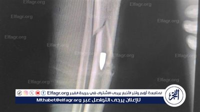 أصيب بطلق نارى يوم العيد..مستشفى قنا العام ينقذ شابًا من مضاعفات خطيرة بالساق