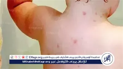 جدرى القرود يتفشى في 49 دولة ويصيب أكثر من 6.8 مليون شخص.. والصحة العالمية تعلن استمرار حالة الطوارئ