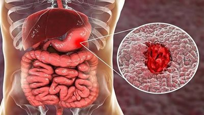 سرطان القولون: المرض الصامت الذي يصيب الشباب.. تعرف على الأعراض وأحدث طرق العلاج والوقاية