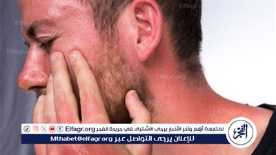 حروق الشمس في الصيف.. كيف تتجنبها وما هي طرق علاجها الفعالة؟