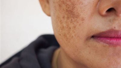 أضرار أشعة الشمس والشيخوخة المبكرة.. كيف تسرّع الشمس زحف الزمن على بشرتك؟