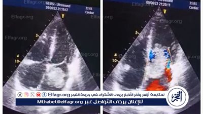 فريق طبي بجامعة أسيوط ينجح في إجراء جراحة معقدة لمريض يعاني من ورم بالقلب