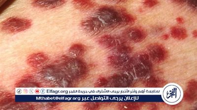 الأمم المتحدة تحذر: خفض التمويل الدولي يُهدد بعودة كارثية لوباء الإيدز عالميًا