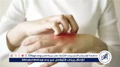 فاكسيرا تكشف تفاصيل علاج الحزام الناري وطرق الوقاية منه