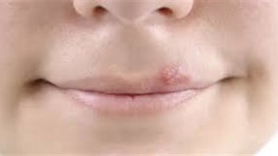 هربس الشفاه.. ما هو وكيف نتعامل معه؟