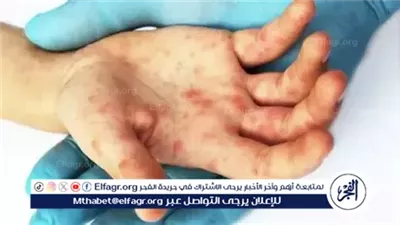 ظهور فيروس اليد والفم والقدم (HFMD) بين طلاب مدرسة في الجيزة.. تفاصيل وإجراءات عاجلة لطمأنة الأهالي