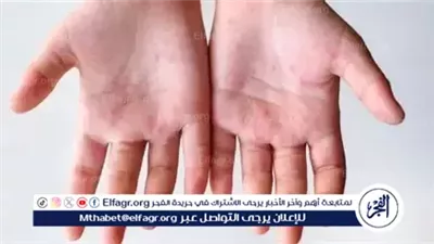 من أين يأتي فيروس اليد والفم والقدم وكيف ينتقل؟ (تفاصيل)