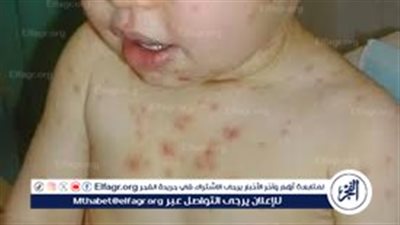 بعد تسجيل 24 حالة إصابة.. اعرف إزاي تحمي طفلك من الجدري المائي
