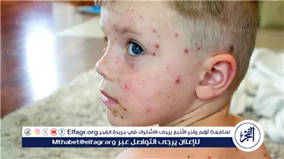 مرض الجدري يعود إلى الواجهة مع موسم العدوى الفيروسية.. إليك الأعراض وطرق الوقاية