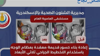 نجاح أول جراحة دقيقة للوجه والفكين بمستشفى العامرية العام