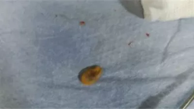 إنقاذ طفل بمستشفى الأطفال التخصصي ببنها بعد تدخل عاجل