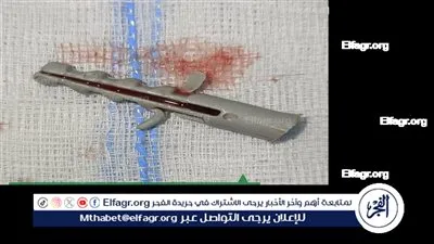 دون تدخل جراحي.. فريق طبي ينقذ سيدة ابتلعت 34 مسمارا منذ 45 يوما بكفر الشيخ