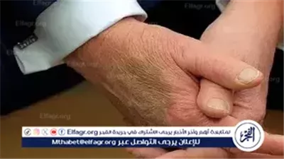 عاجل- ترامب يعترف بتناول جرعات مرتفعة من الأسبرين ويكشف سبب الكدمات على يديه