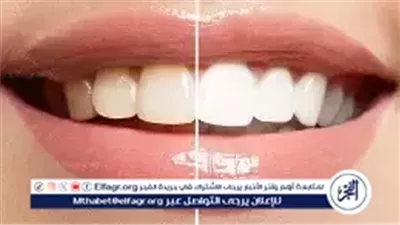 ابتسامتك الأجمل.. أفضل طرق تبييض الأسنان في المنزل بأقل تكلفة ودون كيماويات ضارة
