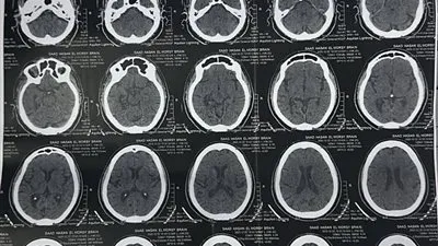 نجاح وحدة إذابة الجلطات بمستشفى السنبلاوين العام في إنقاذ حالتين سكتة دماغية