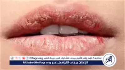 وداعًا لتشققات الشفاه في الشتاء.. 4 خطوات سحرية تحافظ على نعومتها وصحتها