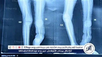 إنجاز جراحي متقدم لفريق طبي يقودة رئيس جامعة سوهاج