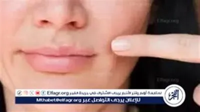 التهاب الجلد حول الفم.. الأسباب الشائعة وطرق علاج فعالة للسيطرة على الأعراض