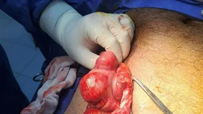 صحة الدقهلية: إنقاذ حياة مريض بفتق نادر خلال تدخل جراحي عاجل بمستشفى ميت سلسيل