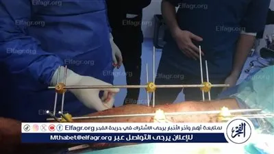 إنقاذ ساق مريض من البتر بعد جراحة دقيقة استغرقت 7 ساعات بمستشفى الفيوم العام
