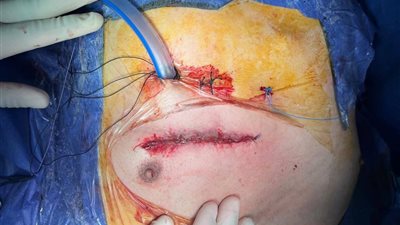  هل تنجح جامعة بني سويف في كسر احتكار جراحات القلب المتطورة وتعميمها بالمحافظات؟