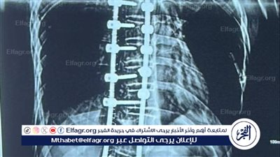 نجاح جراحة دقيقة لشاب يعاني من تشوهات شديدة بالعمود الفقري بمستشفي جامعة الأزهر بأسيوط