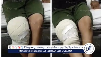 فريق طبي بجامعة أسيوط ينجح في إنهاء معاناة مريض هيموفيليا بعملية دقيقة بمنظار الركبة